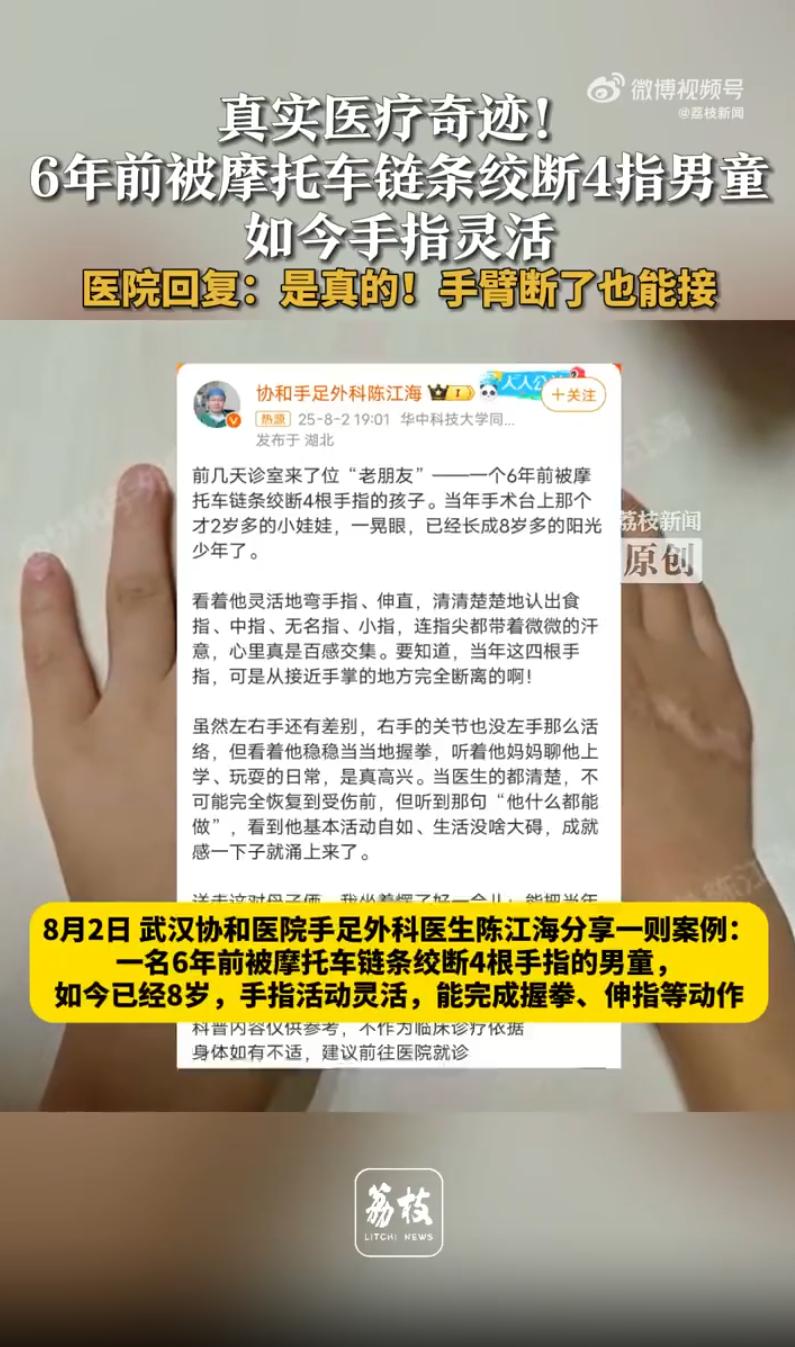 6年前被绞断4指男童如今手指灵活